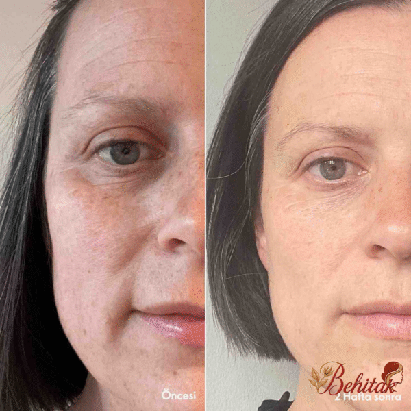 ست ضدچروک و کلاژن ساز رینکل اسموت نوایج پلاس - تصویر 4