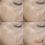 ست ضدچروک و کلاژن ساز رینکل اسموت نوایج پلاس - تصویر 2